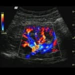 Color Doppler