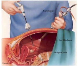 Laparoscopic Surgery